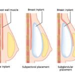 Decoding Breast Augmentation Costs: What Every Patient Should Know
